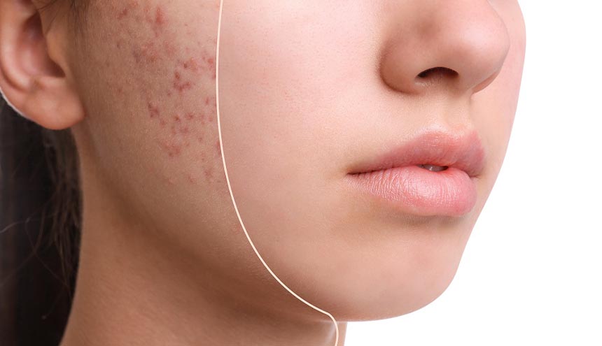 Kulit Berjerawat? Ini Treatment yang Bisa Kamu Coba untuk Mengatasinya