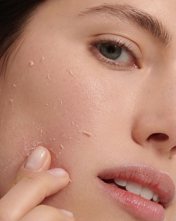 Perawatan Jerawat: Kapan Cukup di Rumah, dan Kapan Harus ke Klinik?