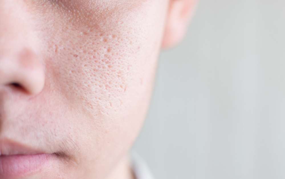 Pori-Pori Wajah Terlihat Besar? Ini Cara Mengecilkannya Secara Efektif