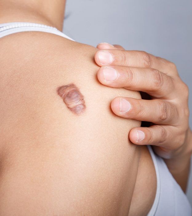 Benarkah Injeksi Keloid Efektif? Ini Pengalaman Klien di Reglow Clinic