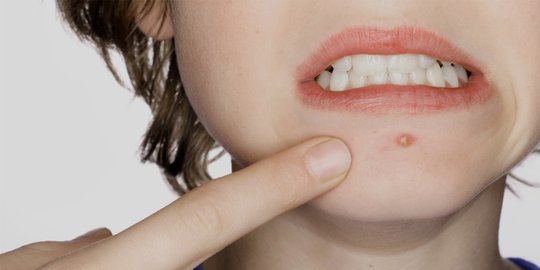 Cara Ampuh Mengatasi Jerawat Saat Menstruasi