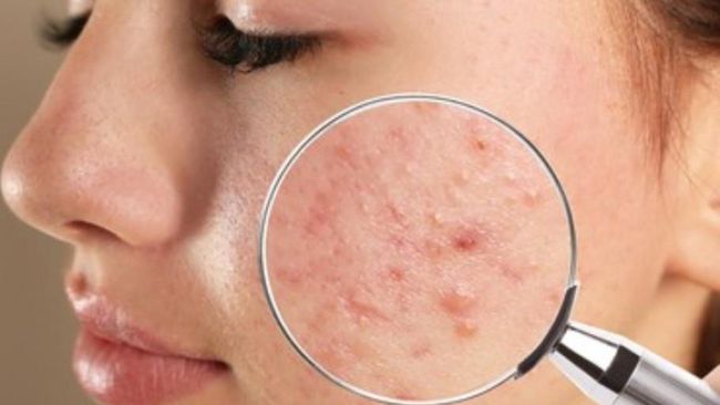 Penyebab Bruntusan di Wajah & Solusi Tepat dari Dermatolog